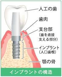 インプラント